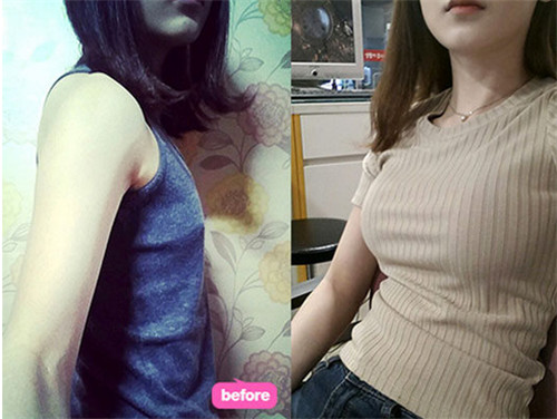 韩国ID假体隆胸对比图