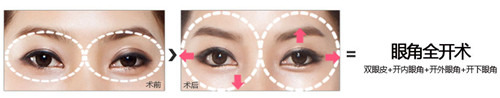 韩国A特双眼皮整形手术