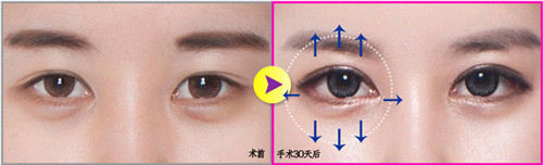 韩国A特双眼皮整形对比
