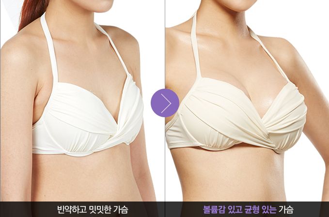 韩国TL假体隆胸对比