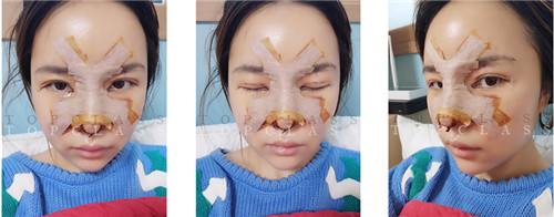 韩国topclass整形外科眼整形术后一周