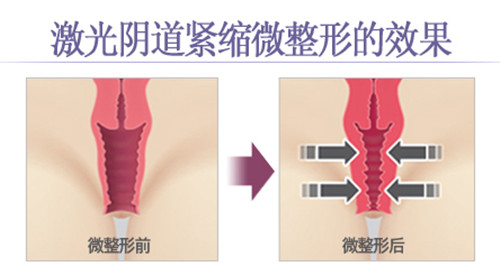 韩国阴道整形效果好吗？如妍和好手艺选哪家？