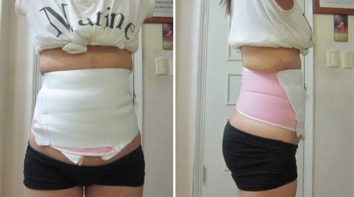 腹部抽脂影响怀孕吗