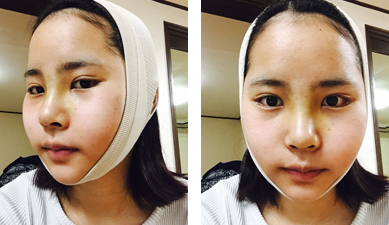 韩国爱琳做面部轮廓手术两周后