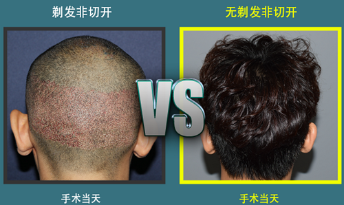 韩国多娜和JP植发对比，究竟谁才是毛发移植高手？