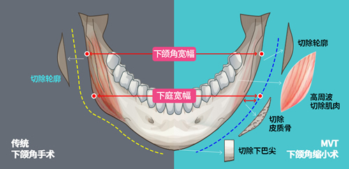 韩国MVT下颌角整形技术