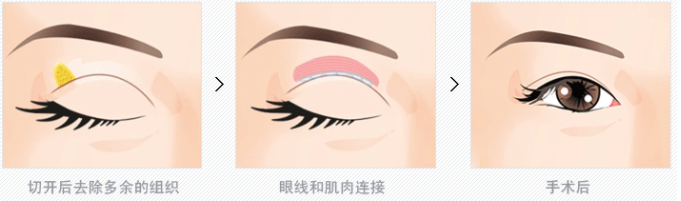 韩国双皮眼皮手术示意图