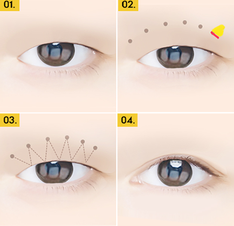双眼皮手术过程图