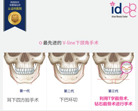 韩国下颌角整形哪家强?ID医院、灰姑娘整形医院