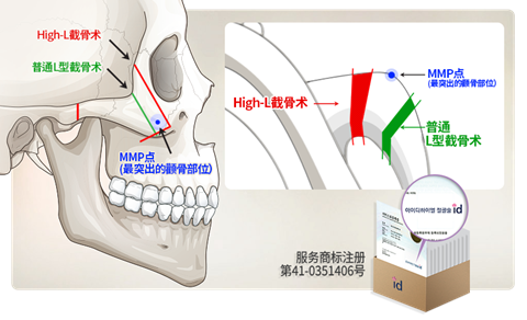 ID整形医院 用High-L颧骨缩小手术征服你的高颧骨