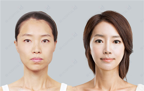韩国ID双眼皮手术