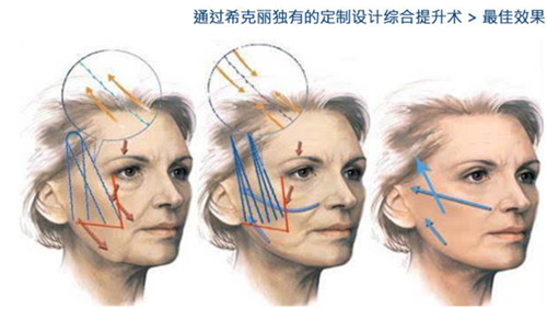 韩国希克丽医院面部线雕提升手术 瘦脸提升双功效