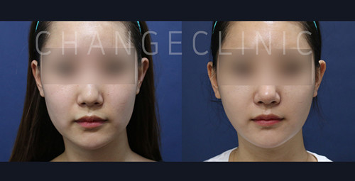 韩国体引脂整形医院面部吸脂对比案例图