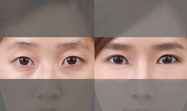 韩国原辰去黑眼圈有哪些方法？效果好吗？