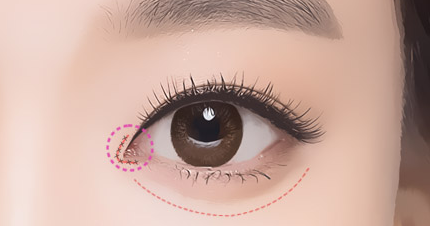 开眼角疤痕修复方法过程示意图