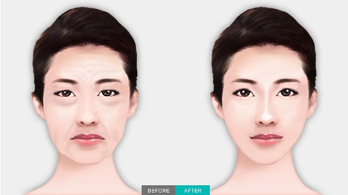 面部线提升手术 秀美颜和清潭优整形外科哪家好？