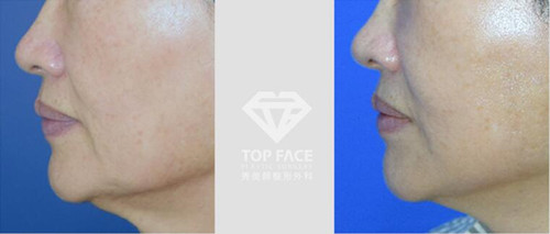 面部线提升手术 秀美颜和清潭优整形外科哪家好？