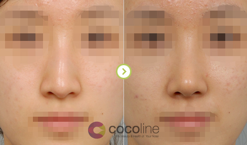 cocoline隆鼻修复矫正对比图
