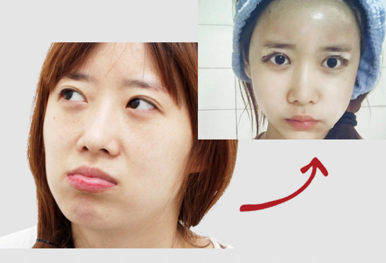 韩国面部脂肪填充全脸术前术后对比示意图