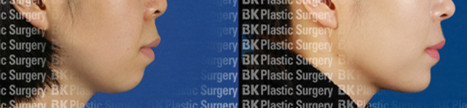 bk医院下巴脂肪填充对比图