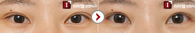 韩国爱婷整形医院双眼皮修复案例对比图