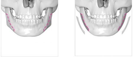 韩国gng下颌角皮质截骨示意图
