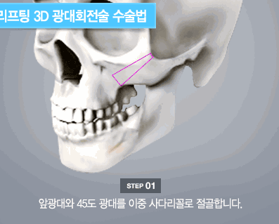 3D颧骨手术示意图
