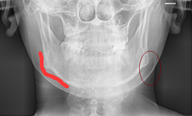 COOKI医院下颌角CT照片