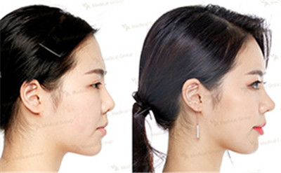 韩国JK3D鼻整形+眼整形+额头提升对比案例