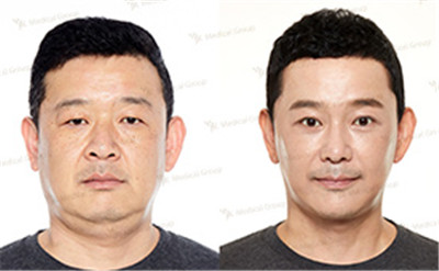 韩国JK双眼皮手术日记