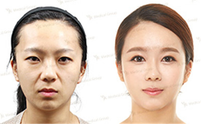 韩国JK医院全脸自体脂肪填充案例