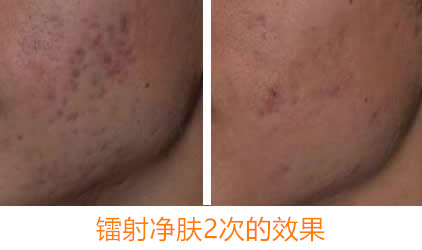 镭射净肤与皮秒激光傻傻分不清 非常爱美