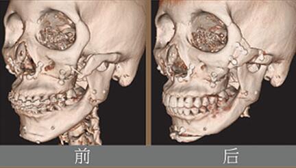 面部轮廓修复之颧骨修复术