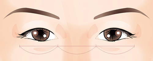 韩国原辰整形外科双眼皮手术特点展示