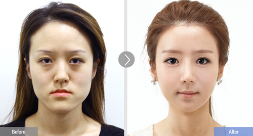 韩国face-line整形外科双鄂手术案例对比