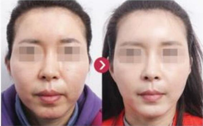 韩国如妃整形外科面部抗衰老手术对比案例