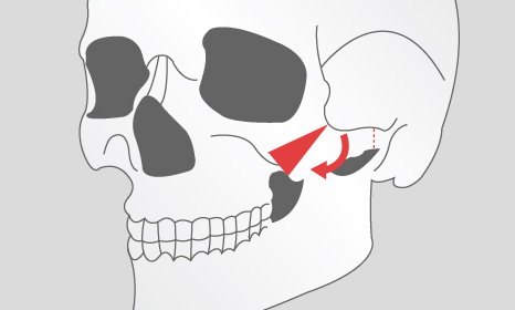 3D颧骨旋转术手术方法科普
