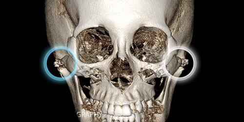 3D颧骨旋转术改善原理展示