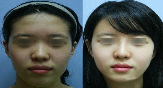 鼻部 胸部 眼眉 身体塑形 抗衰老 皮肤 其他 白瓷娃娃治疗过程中皮肤