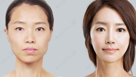 韩国ID医院鼻子整形对比