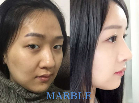 韩国玛博尔眼鼻整形+脂肪填充案例