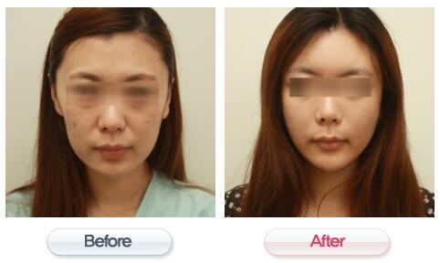 韩国美line整形医院3D全脸脂肪填充对比