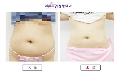 韩国美line整形医院腰腹吸脂对比图