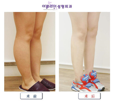 韩国美line整形医院小腿吸脂对比图