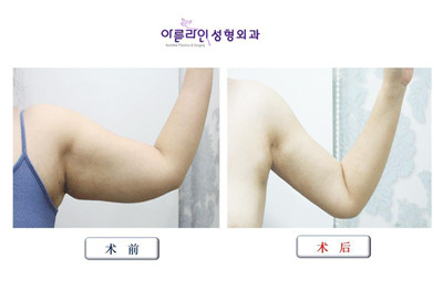 韩国美line整形医院手臂吸脂对比图