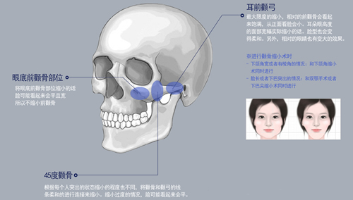 face-line整形外科颧骨缩小优势展示