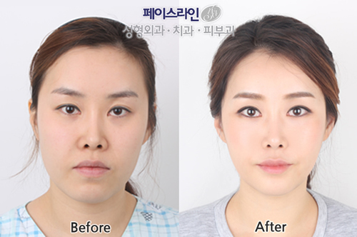 face-line整形外科颧骨缩小手术案例