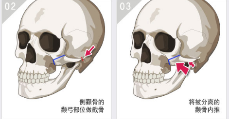 3D均衡颧骨缩小手术示意图