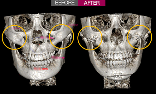 一路美整形外科颧骨整形术后CT拍摄