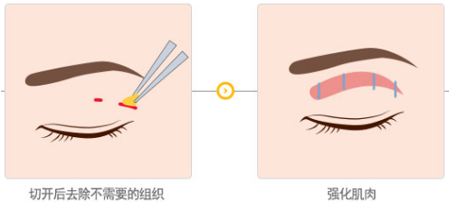 韩式三点双眼皮手术示意图